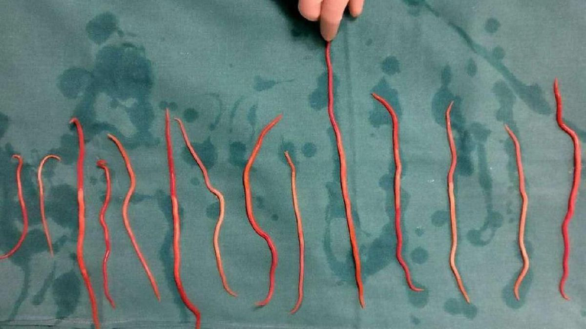 Benarkah Cacing Bisa Keluar Lewat Muntah dan BAB? Ini Jawaban Dokter