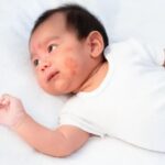 3 Kesalahan Perawatan Kulit Eksim Anak yang Sering Tidak Disadari