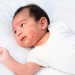 Pentingnya Konsultasi ke Dokter untuk Menangani Anak dengan Alergi Susu Sapi