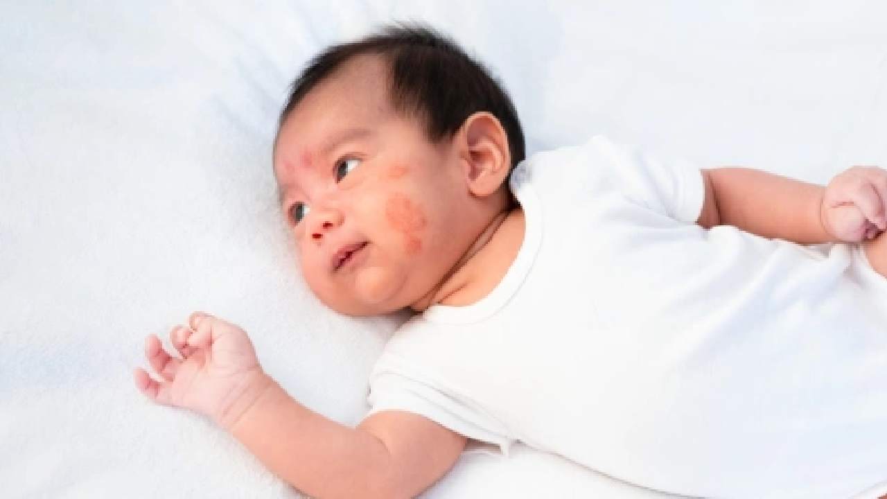 Pentingnya Konsultasi ke Dokter untuk Menangani Anak dengan Alergi Susu Sapi